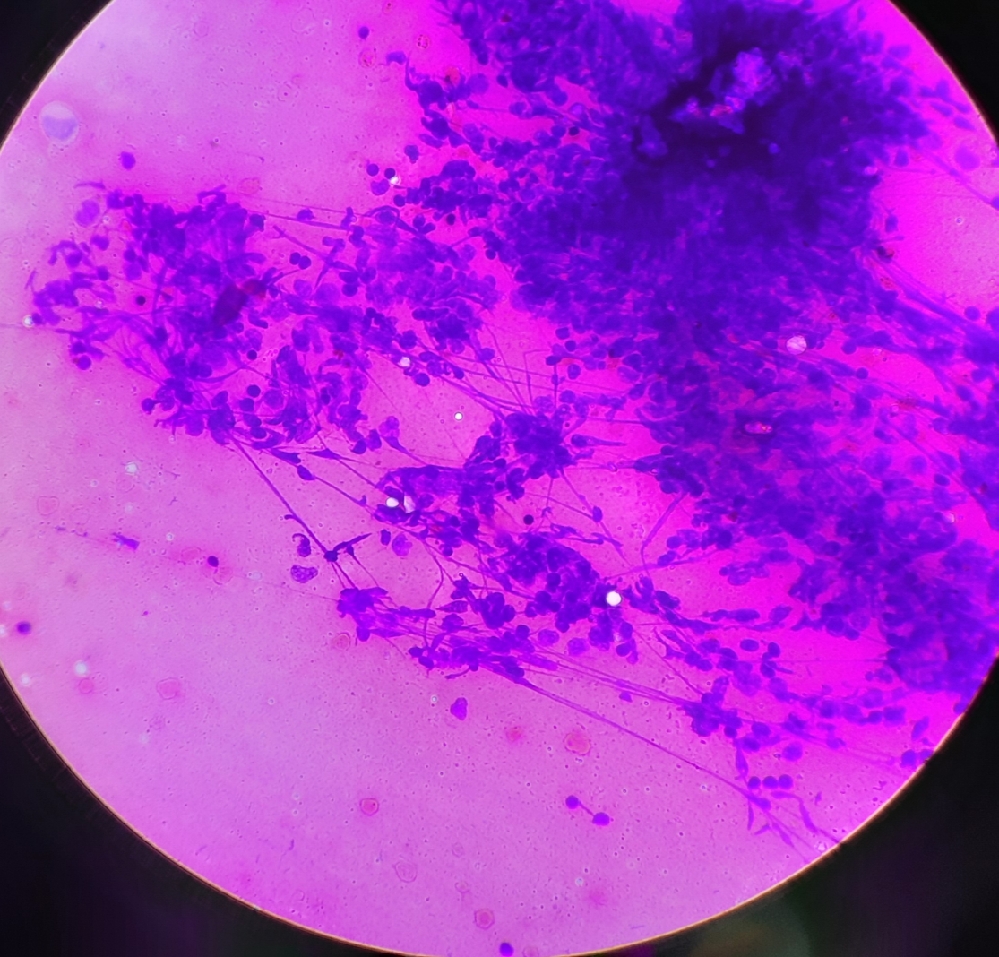 FINE NEEDLE ASPIRATION CYTOLOGY fine-needle-aspiration-cytology