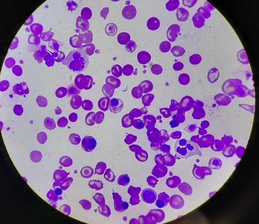 FINE NEEDLE ASPIRATION CYTOLOGY fine-needle-aspiration-cytology