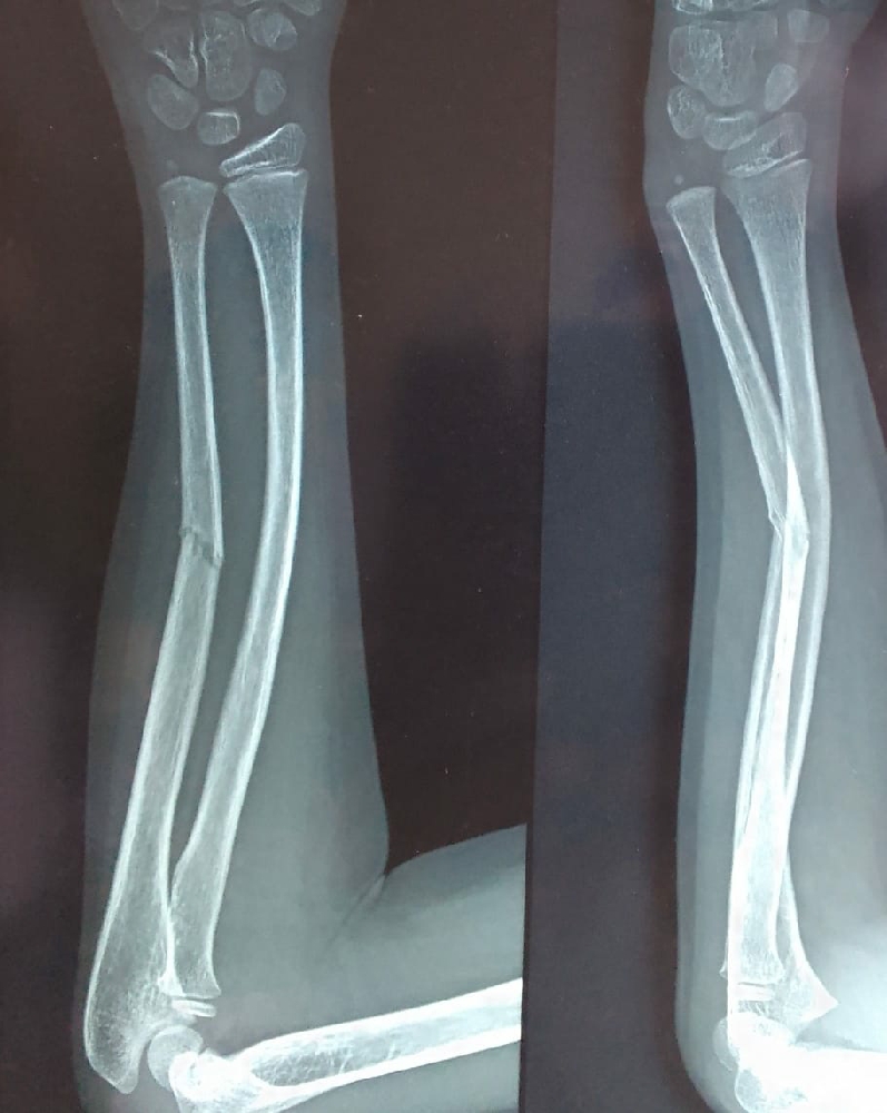 Green stick fracture