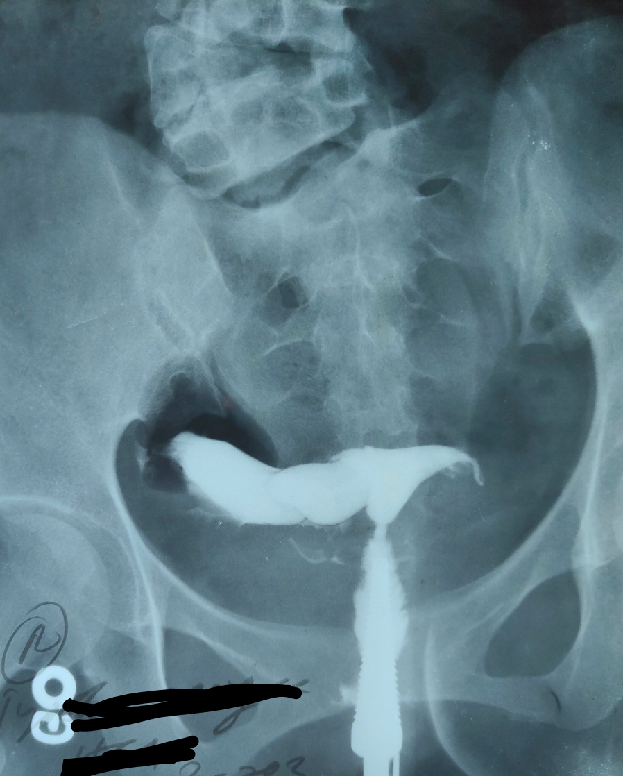 Hydrosalpinx with tubal blockage.