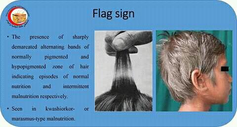 Flag Sign Kwashiorkor Best Picture Of Imagesco Org Important Sign